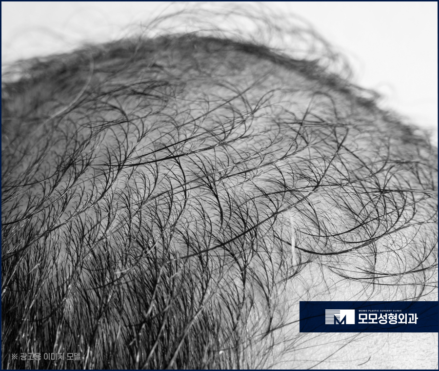 정수리모발이식비용 얼굴 이미지를 고려하며 관련 이미지 3