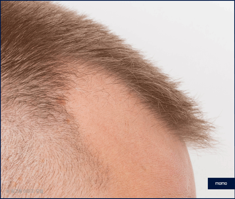 엠자이마 탈모 헤어라인 모발이식으로 관리하기 관련 이미지 12