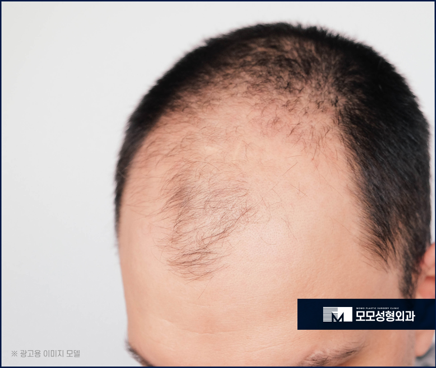 M자모발이식가격 참고해야 할 사항은 관련 이미지 6