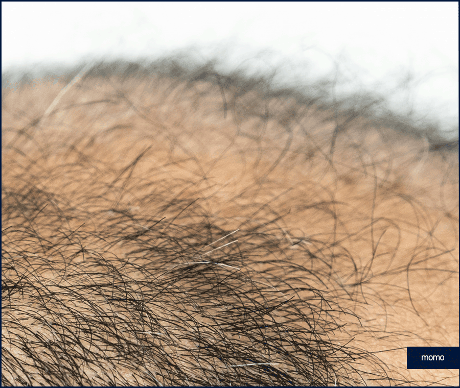 모발이식재수술 원인 및 성공을 위한 핵심 2가지 관련 이미지 11