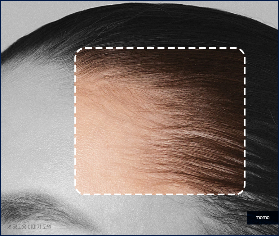 여성 모발이식 자연스러운 변화를 만드는 관련 이미지 8