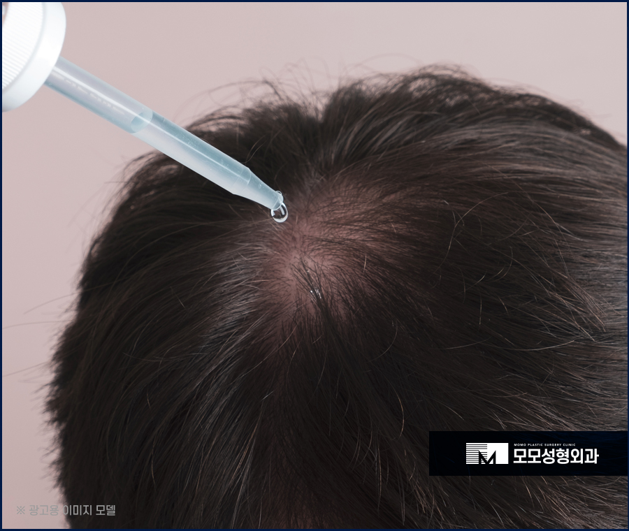 모발이식 한달 어떤 변화가 나타나며 주의할 점은 관련 이미지 7