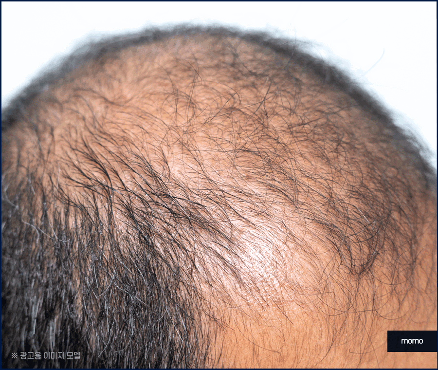 비절개 모발이식 후기와 함께 꼭 알아볼 이것! 관련 이미지 9