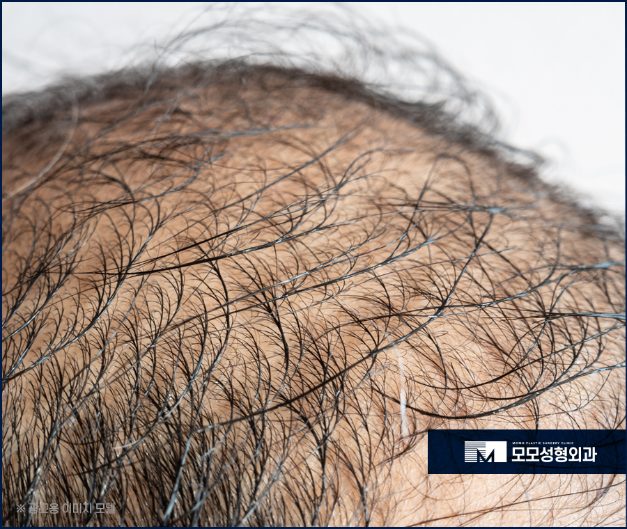 신사역탈모병원 예후가 우수하려면 관련 이미지 3