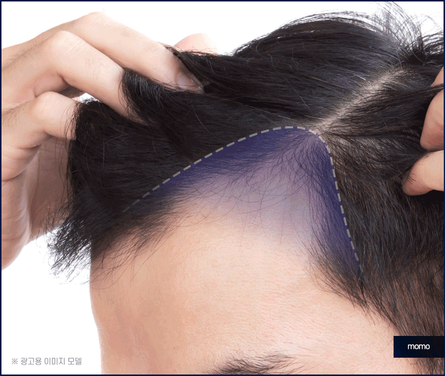 머리심기 비용 및 시술별 장단점 알아보기 관련 이미지 3