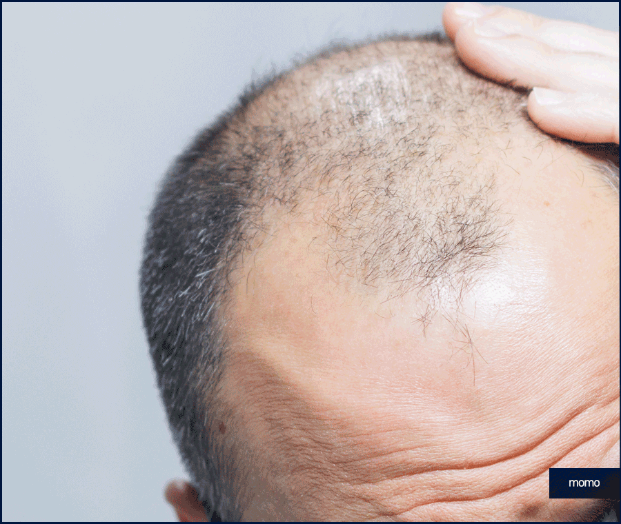 탈모약 처방 병원 꼼꼼한 진단하는 곳을 찾는다면 관련 이미지 3