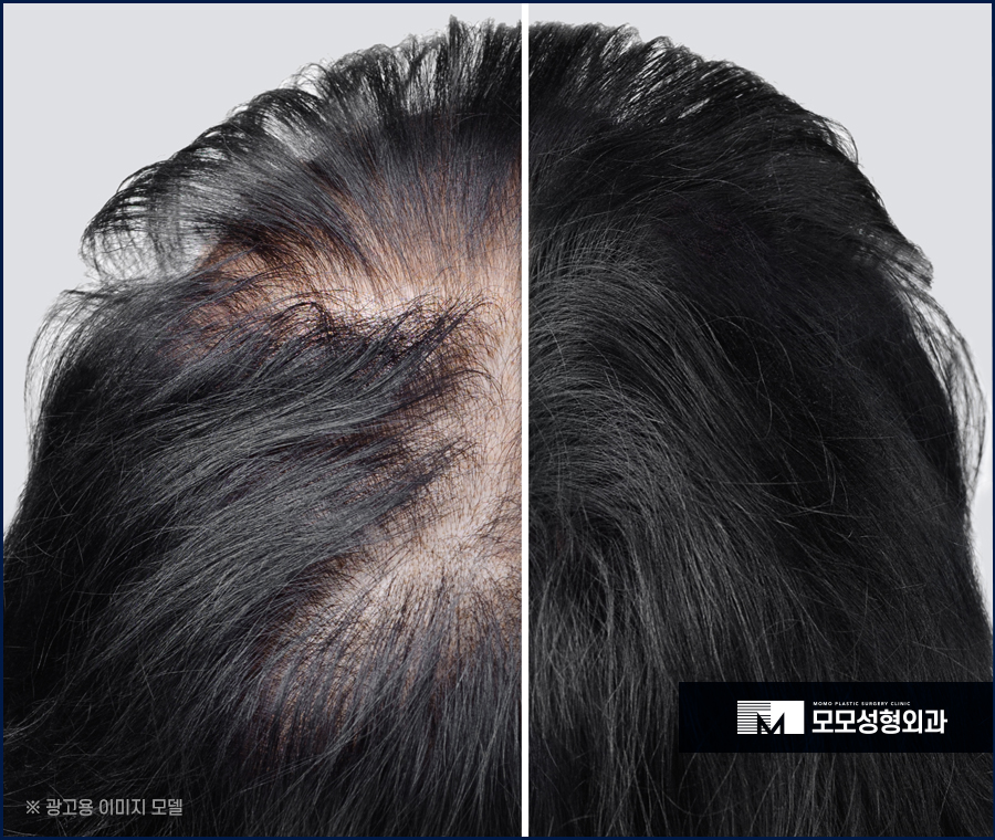 여자M자탈모 외모의 퀄리티를 더하는 보강 방법 관련 이미지 4