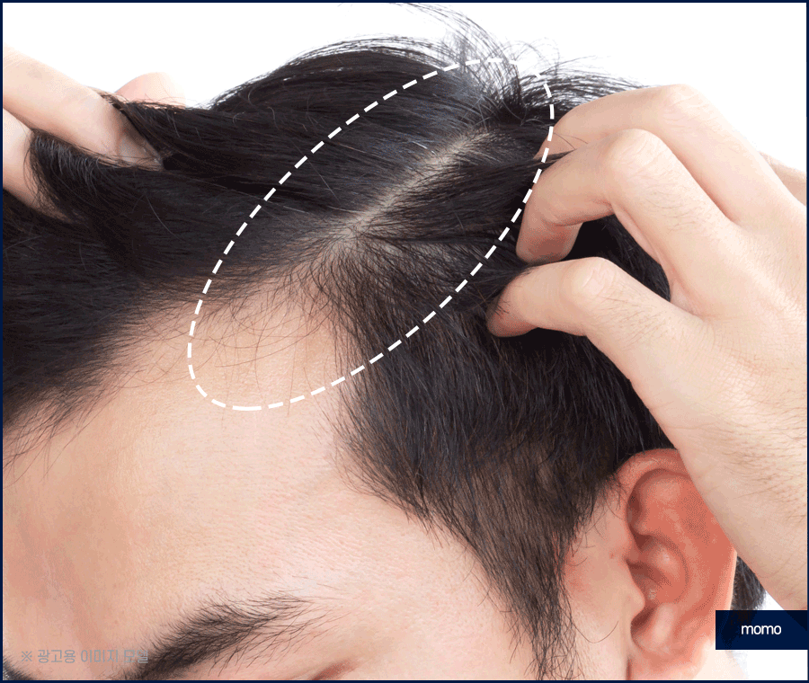 남자 모발이식 비용, 방법까지 꼼꼼히 확인하세요! 관련 이미지 8