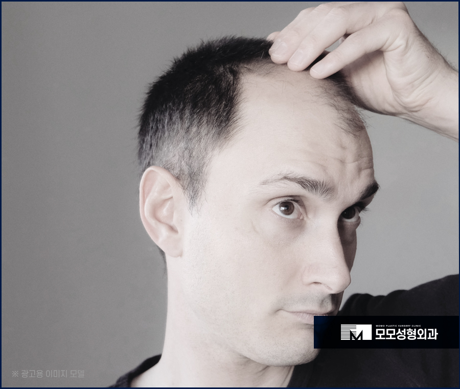 비절개모발이식비용을 기준하는 요건은 관련 이미지 4