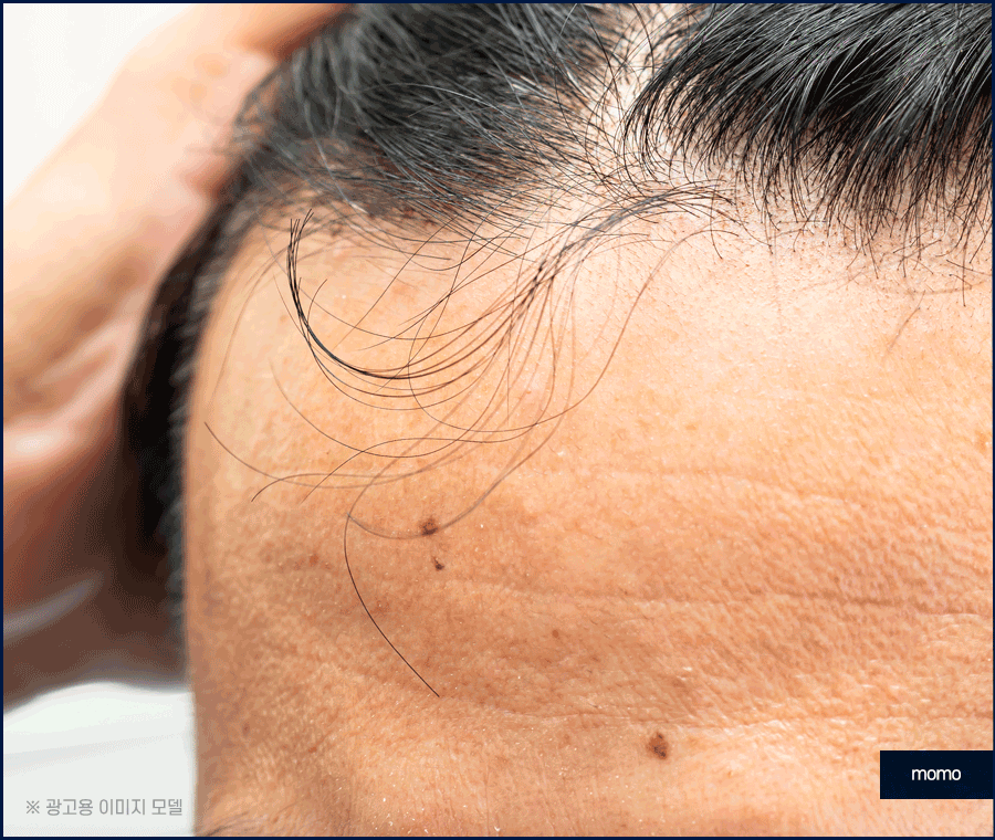 여자M자탈모 회복을 위한 맞춤 솔루션 관련 이미지 8