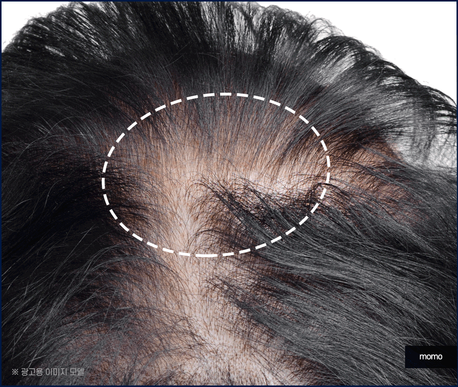 압구정모발이식 원하던 모습을 찾는 포인트 관련 이미지 5
