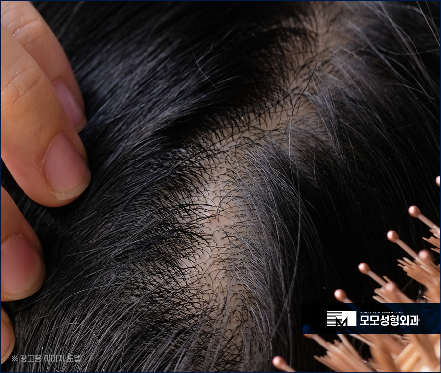 새치 뽑으면 생기는 문제 및 관리 방법까지 관련 이미지 5