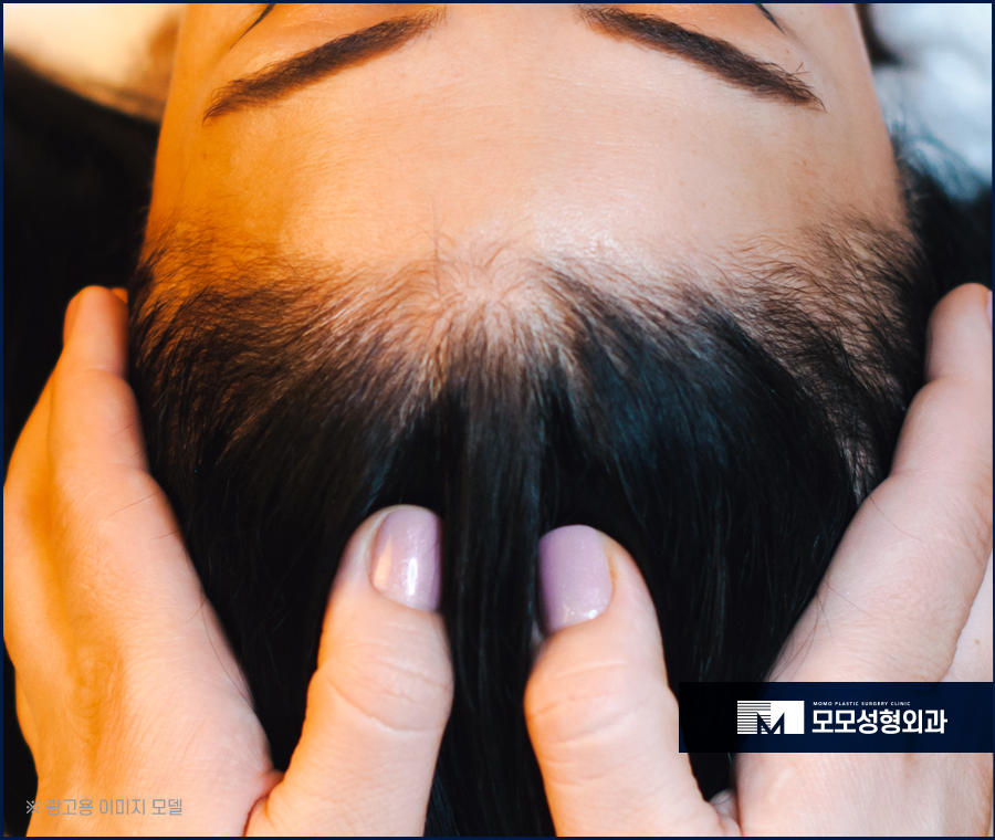 두피모낭염증상 원인을 알고 대처하는 관련 이미지 3