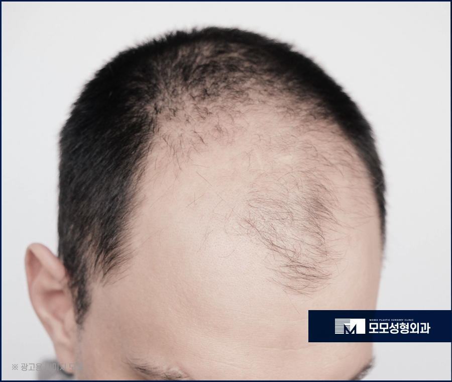 넓은이마모발이식 불규칙한 라인이 고민일 때에는 관련 이미지 2