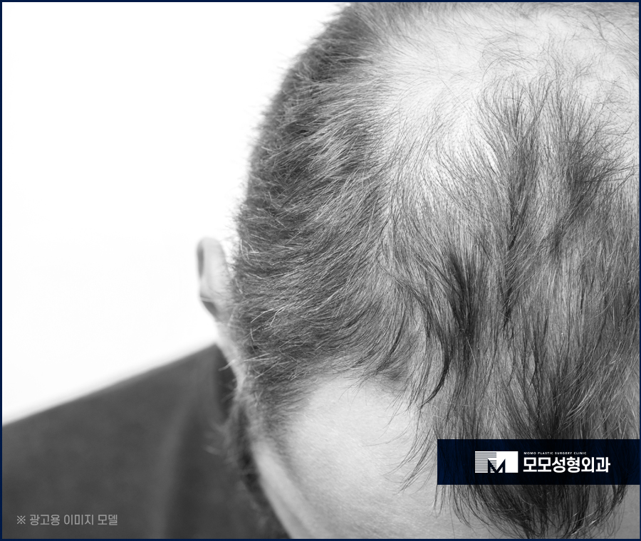 압구정모발이식 당당한 외모 자신감을 위해 관련 이미지 3