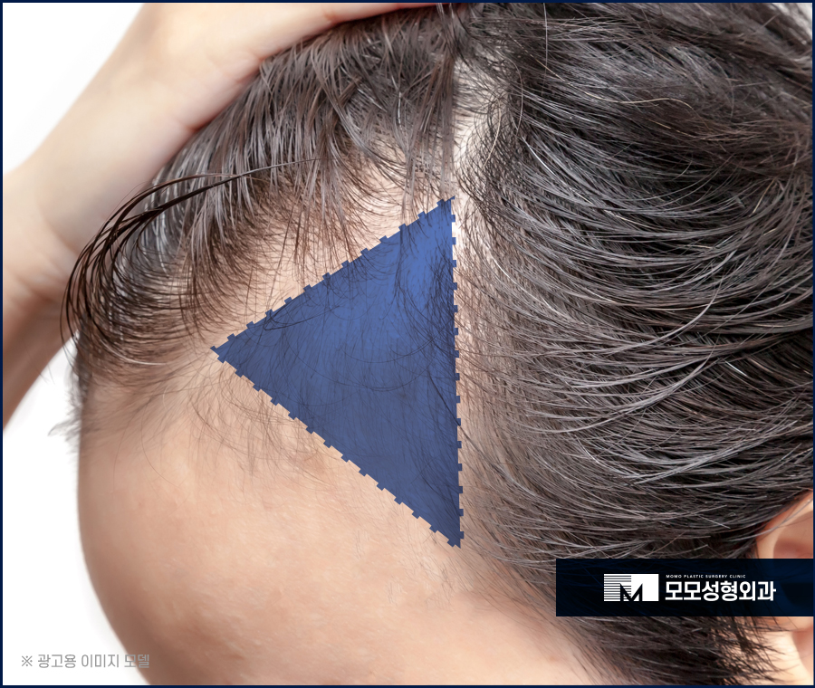 M자 모발이식 비용과 금액대가 달라지는 이유 관련 이미지 6