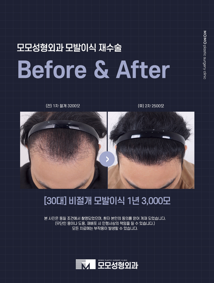 m자탈모초기증상 면밀하게 관찰해야 하는 이유 관련 이미지 6