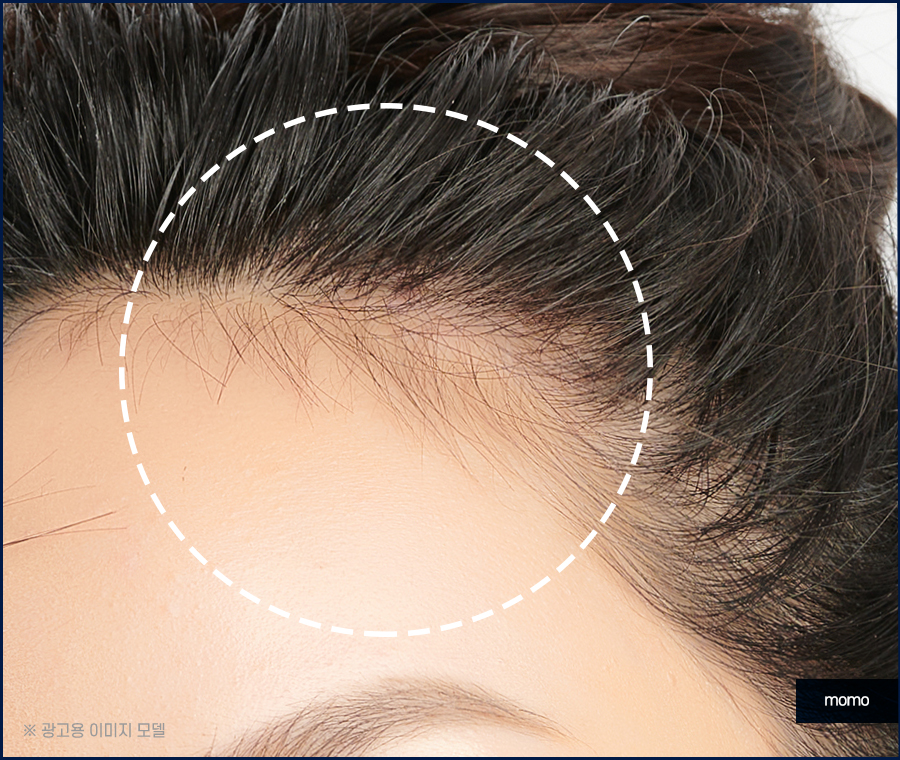 여자 헤어라인 모발이식 외모 자신감을 높이는 관련 이미지 5