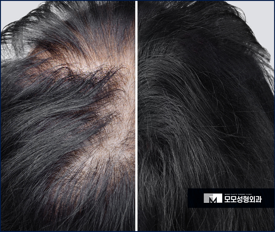 비절개모발이식가격 호전되는 방향으로 관련 이미지 4