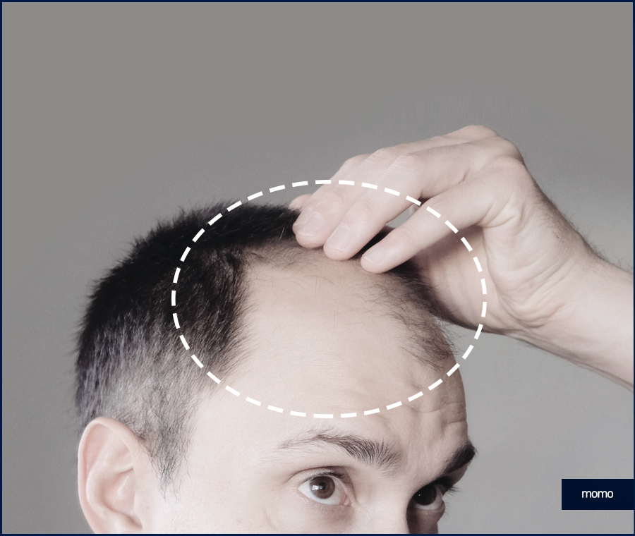 넓은이마모발이식 헤어 라인을 깔끔히 정리하는 관련 이미지 5