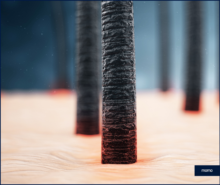 M자모발이식비용 가격 탈모 탈출을 위한 관련 이미지 3