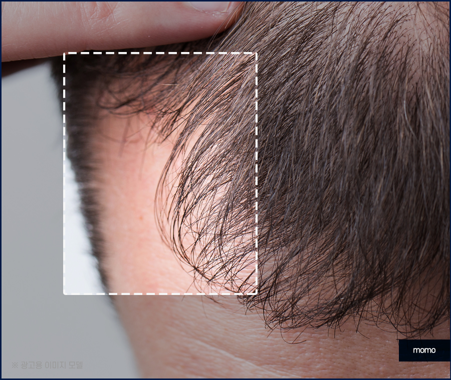 m자 모발이식 가격 달라지게 되는 이유는 관련 이미지 6