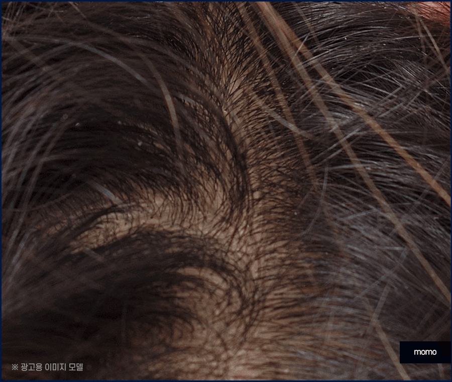여자 정수리 탈모 초기 증상 및 머리카락빠짐 대응 방안 관련 이미지 11