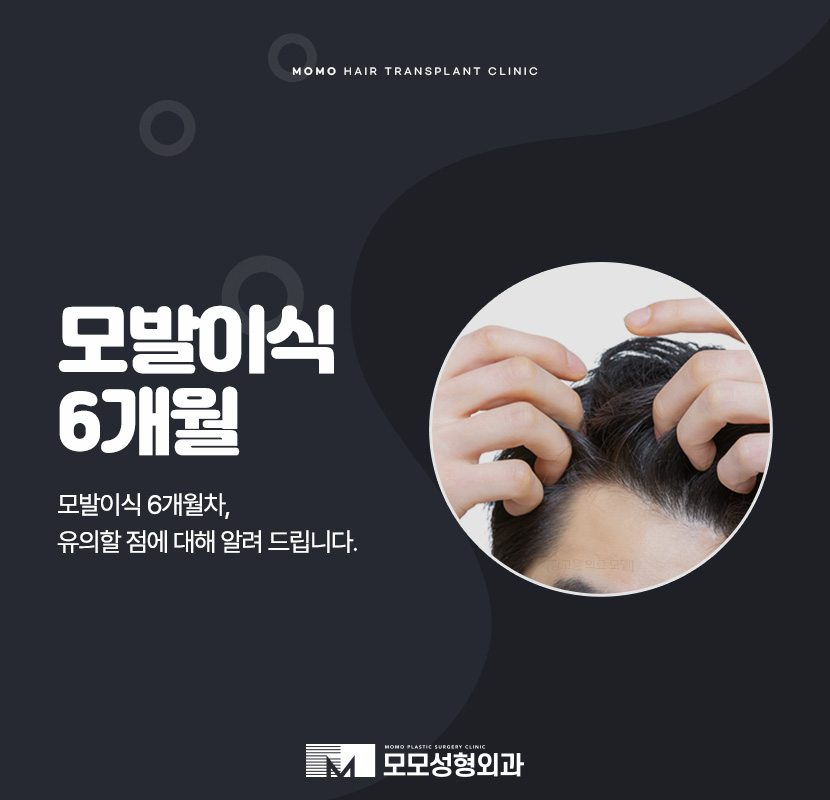 모발이식 6개월 차 변화와 유의할 점에 대해서 관련 이미지 1