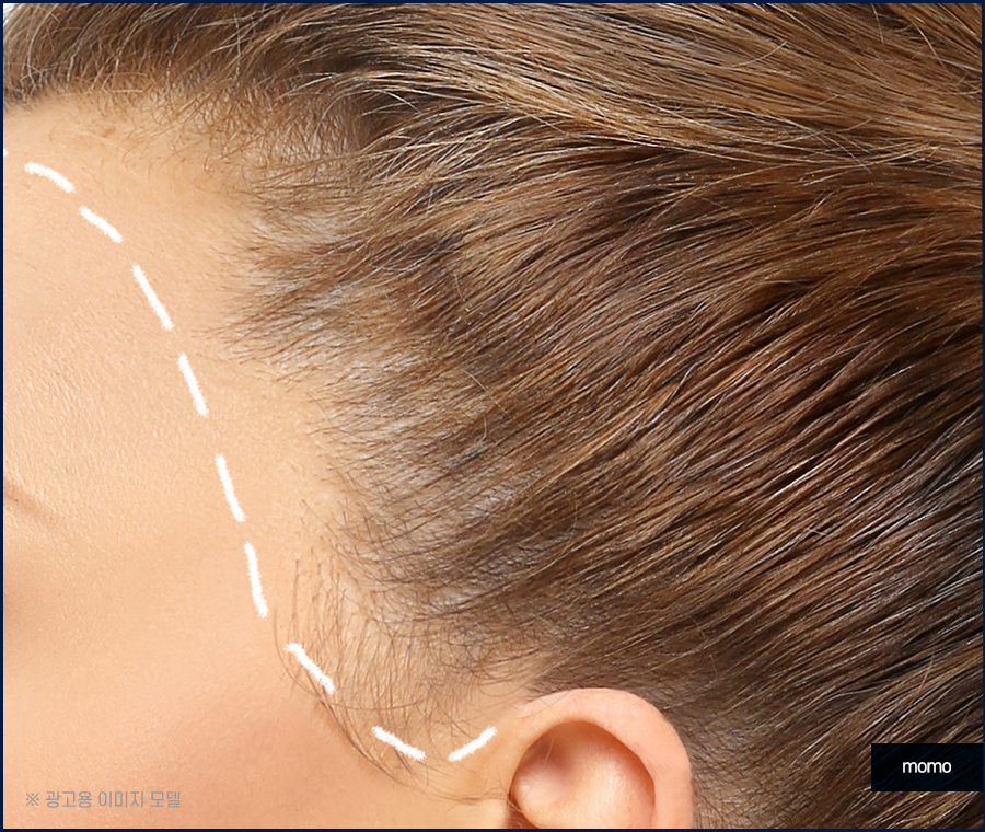 헤어라인모발이식비용 생착률을 높여가면서 관련 이미지 9