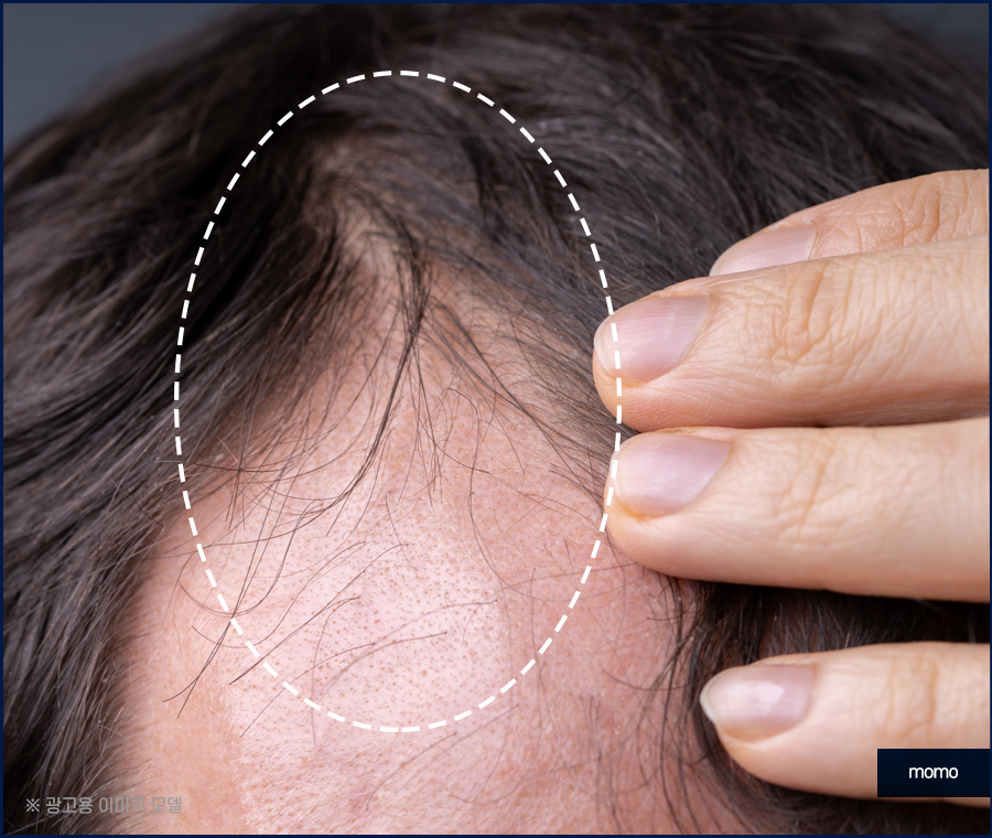 강남 모발이식 정교하게 보완하는 관련 이미지 6