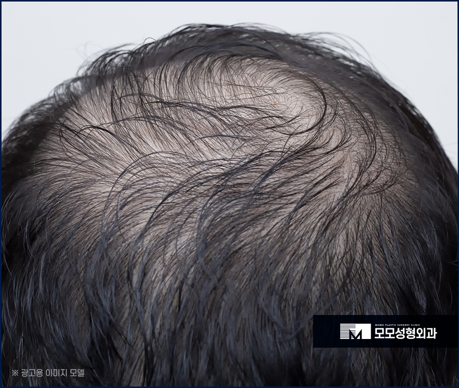 정수리탈모병원 분석부터 꼼꼼하게 하는 곳에서 관련 이미지 3