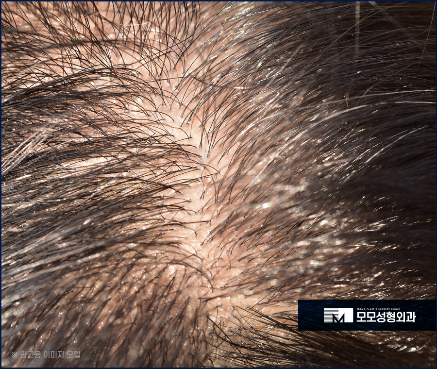 여성 정수리 모발이식 섬세한 집도가 중요한 이유 관련 이미지 4