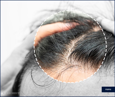 무삭발 모발이식 빠르게 회복하려면 관련 이미지 3