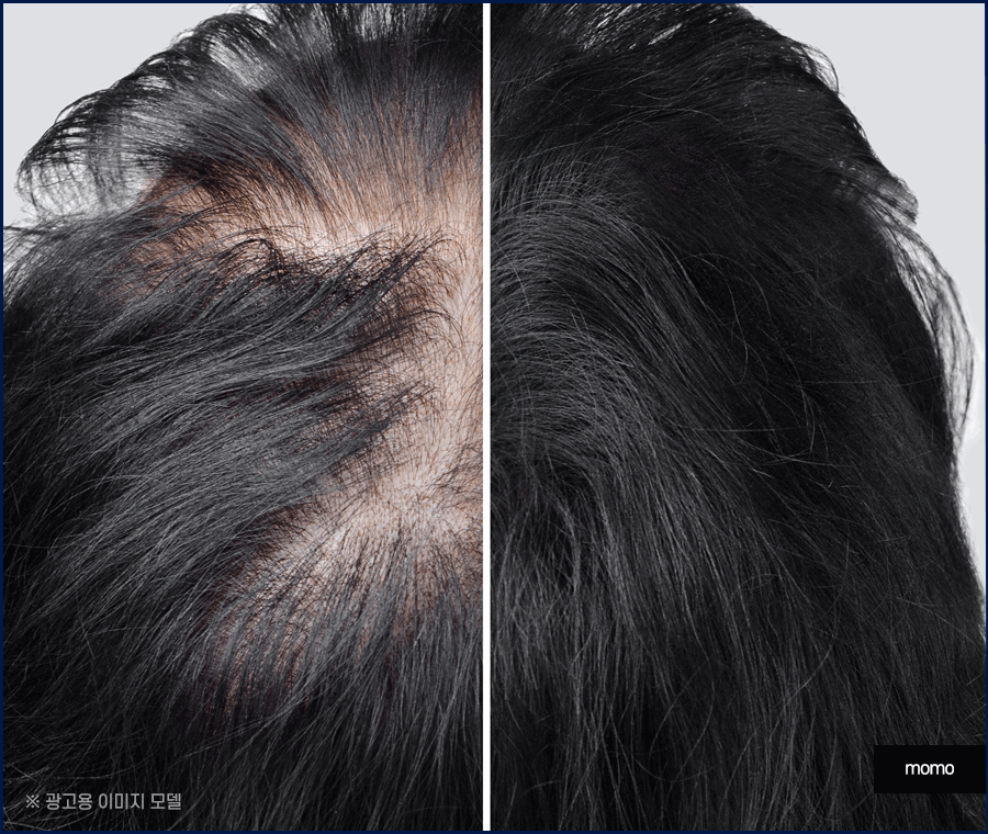 머리심기 비용 및 시술별 장단점 알아보기 관련 이미지 8