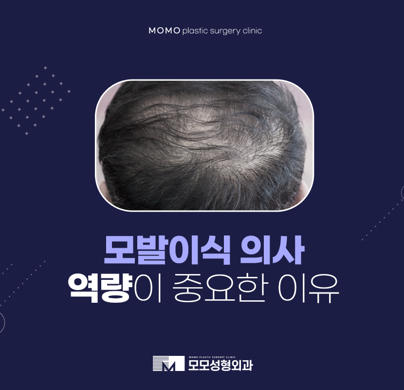모발이식의사 역량이 중요한 이유 관련 이미지 1