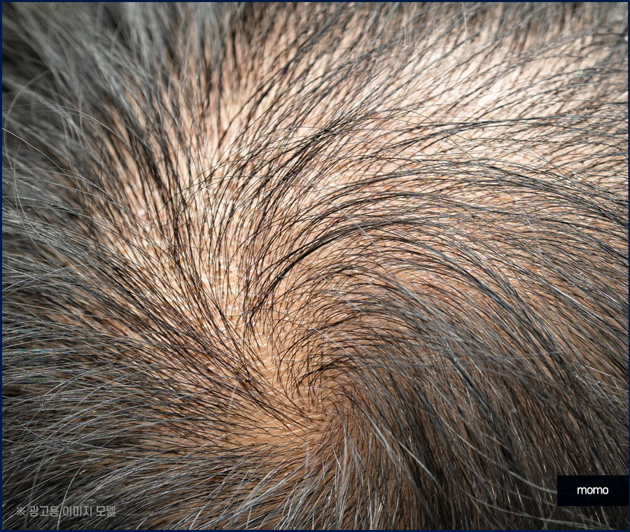 대량 모발이식 확연한 변화를 위해서 관련 이미지 4