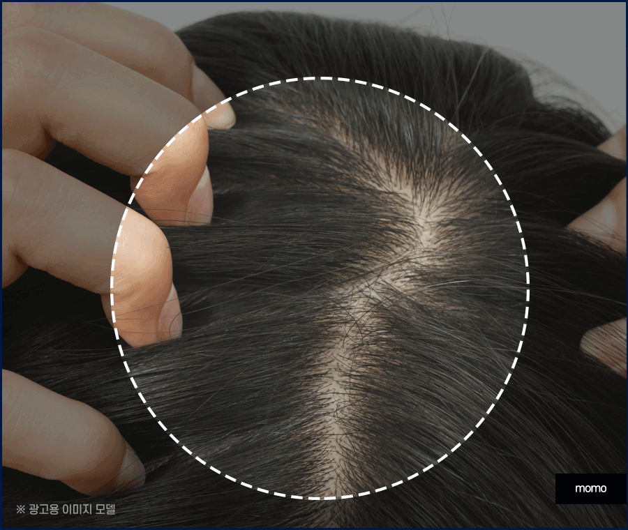 출산후 탈모 자연스럽게 보완하는 방법은 관련 이미지 9