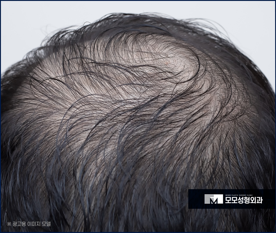 모발이식사후관리 우수한 수준의 예후를 만드는 방법 관련 이미지 2