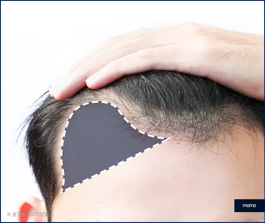 넓은이마모발이식 헤어 라인을 깔끔히 정리하는 관련 이미지 8