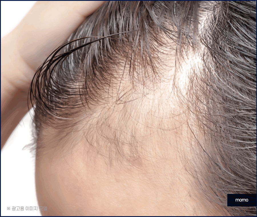 엠자이마 탈모 헤어라인 모발이식으로 관리하기 관련 이미지 8