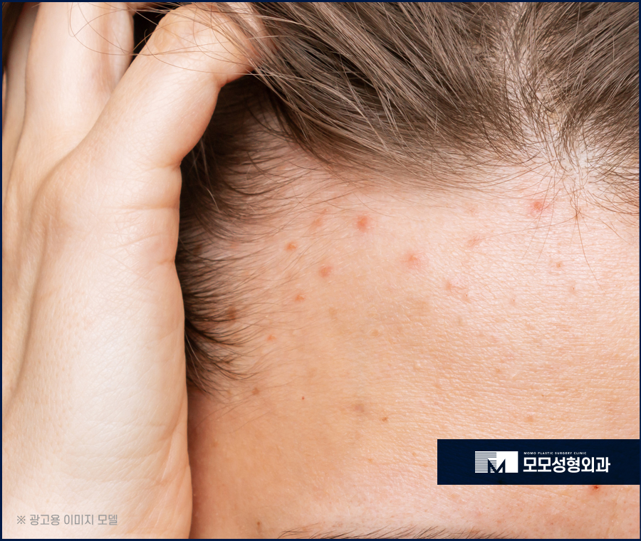 여성헤어라인모발이식 채워 주기 위한 방법은 관련 이미지 5