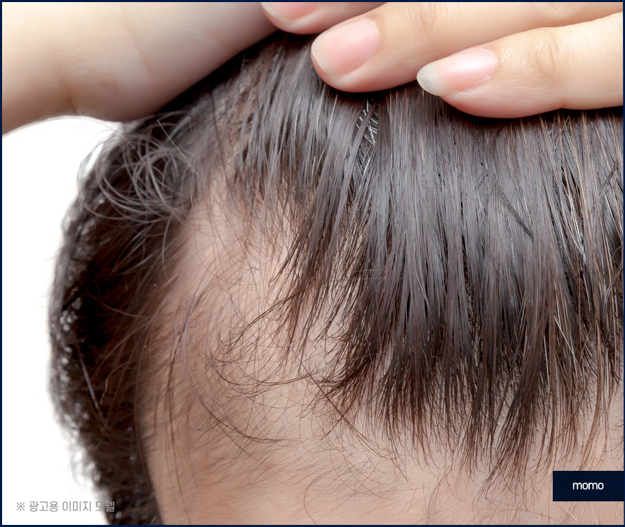 엠자이마 고민 탈출을 위한 모발이식 관련 이미지 8