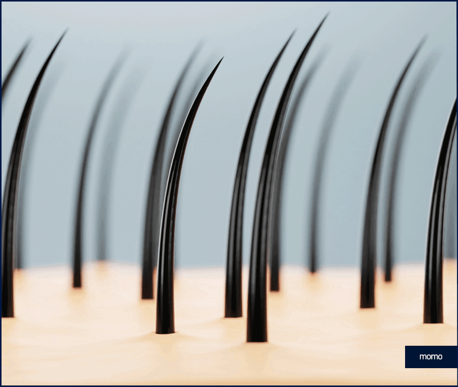 모발이식 생착기간 섬세한 관리가 필요한 이유 관련 이미지 3