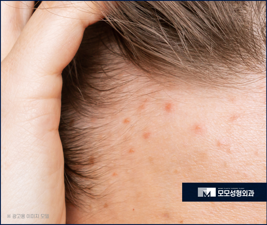 여자앞머리탈모 맞춤 진단으로 채우는 관련 이미지 2