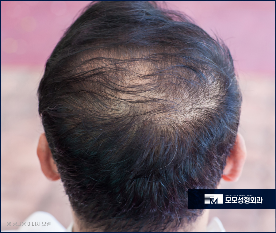 남자연예인모발이식 준수한 외모를 위한 선택 관련 이미지 2