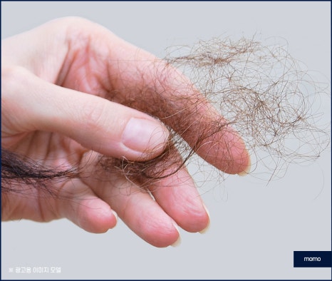 압구정 모발이식 탈모 문제를 해소하는 관련 이미지 4