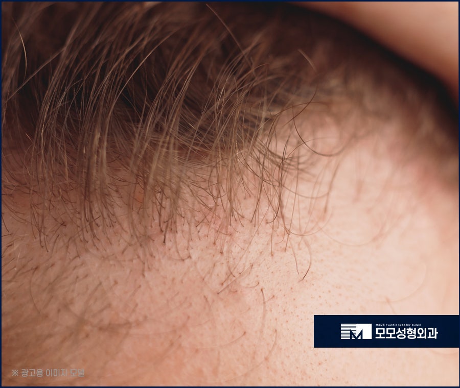 엠자이마 촘촘하게 채워 자연스럽게 보강하는 관련 이미지 5