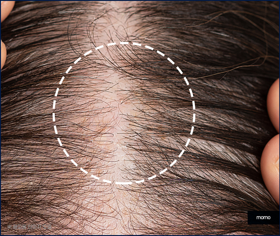 비절개 모발이식 비용 무삭발로 회복까지 빠르게 관련 이미지 3