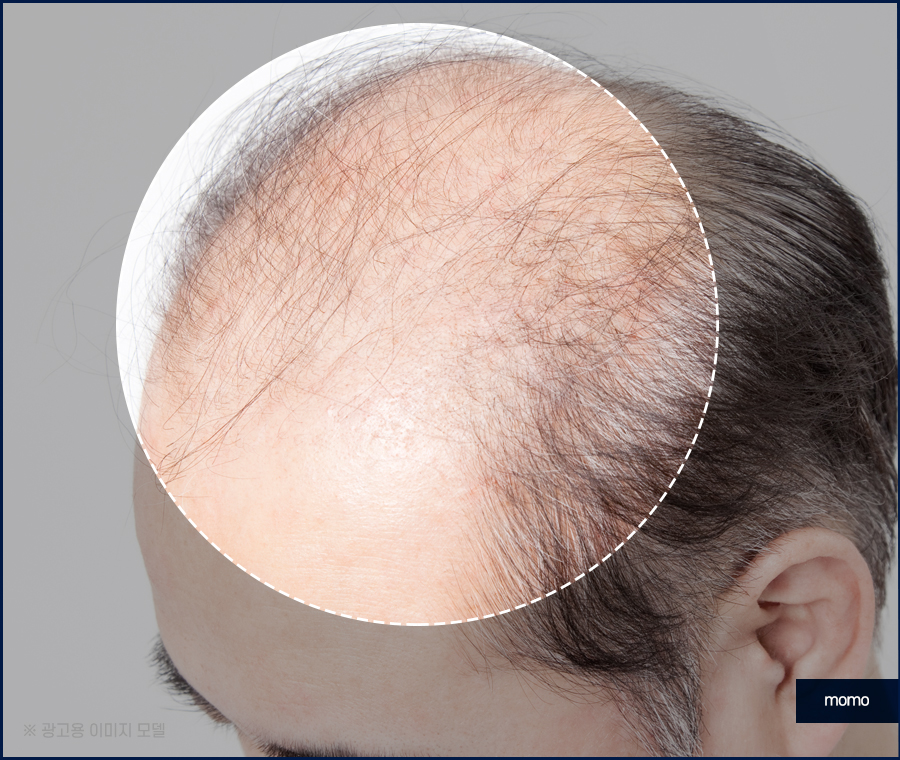 m자탈모초기 현상과 빠르게 대처하면 좋은 포인트는 관련 이미지 4