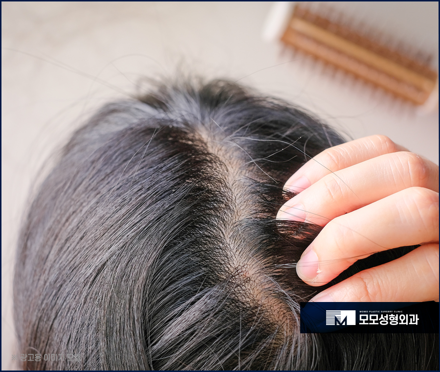 겨울두피가려움 나타나는 원인과 해소 방안 관련 이미지 3